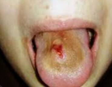 Piercing στη Γλώσσα Επιπλοκές – Θεραπεία – Πρόληψη