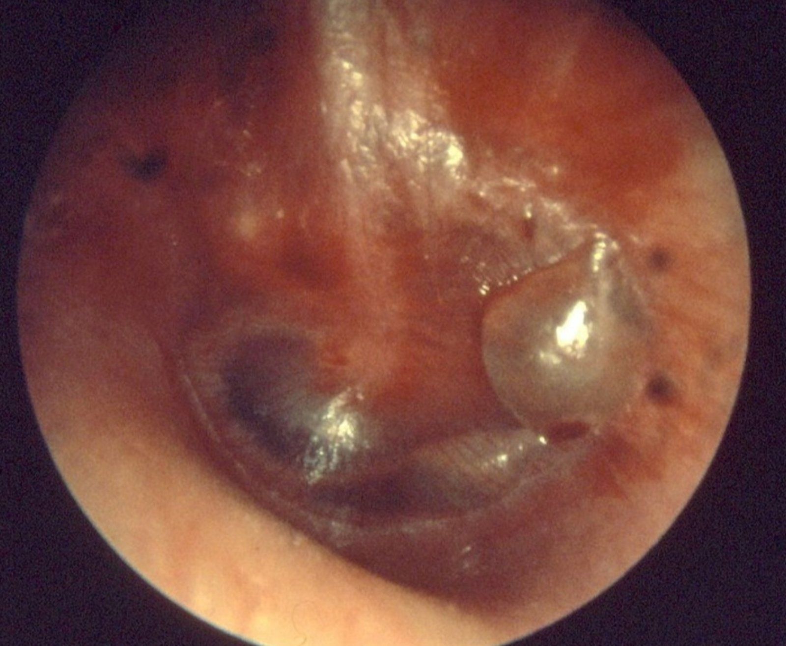 Υγρό στο Αυτί