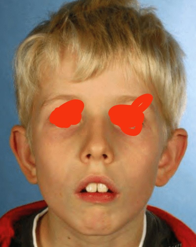 λαρυγγιτιδα