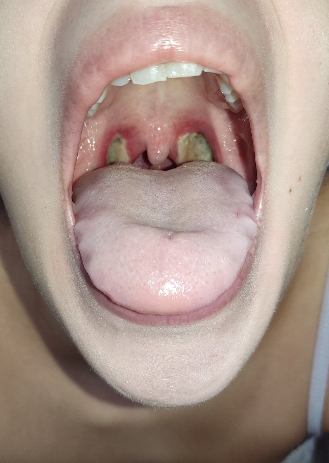 λαρυγγιτιδα