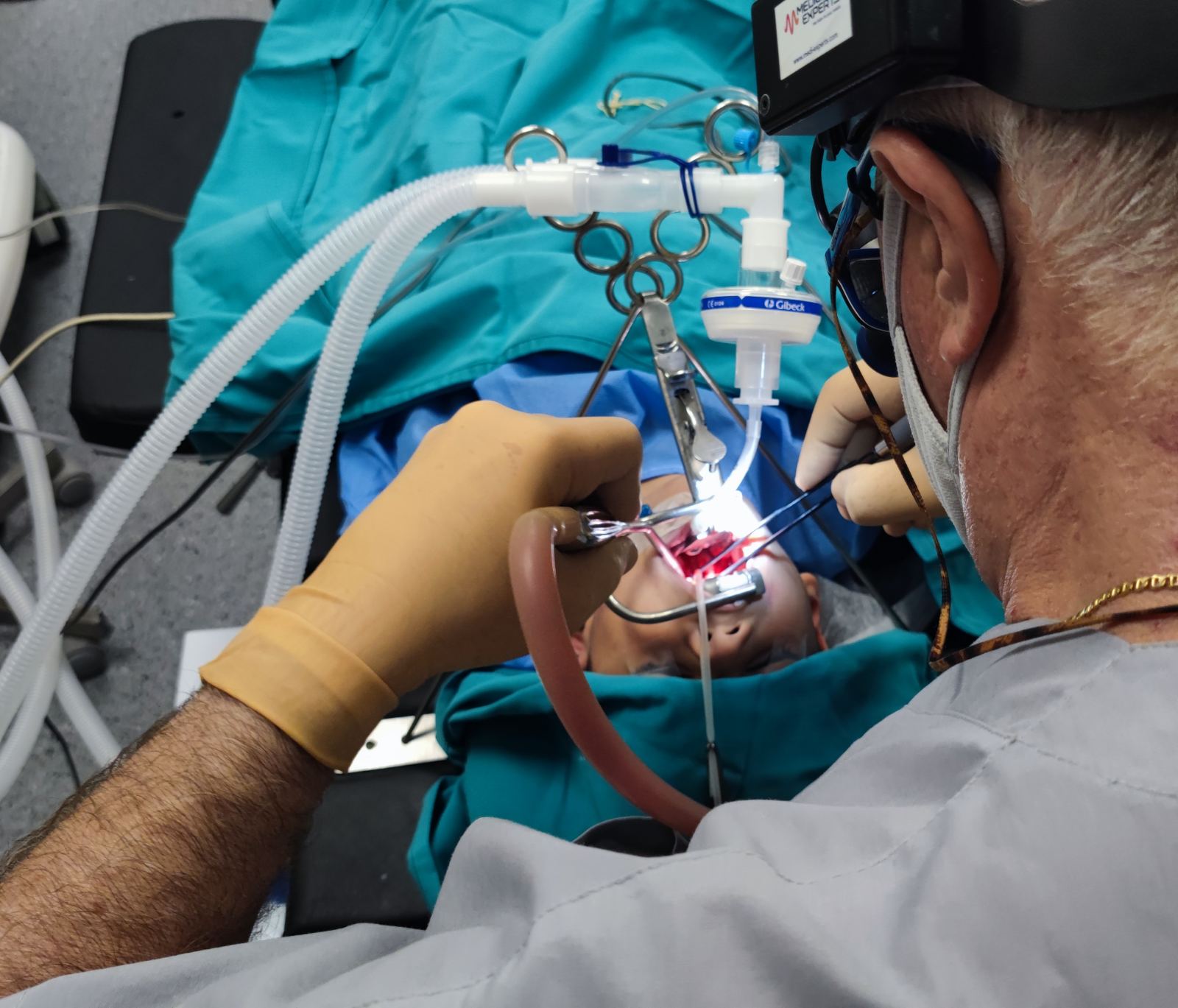 Αμυγδαλεκτομή λαρυγγιτιδα