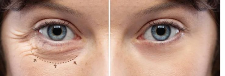 Βλεφαροπλαστική