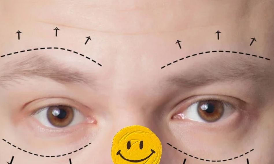 Βλεφαροπλαστική