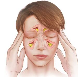 Ιγμορίτιδα