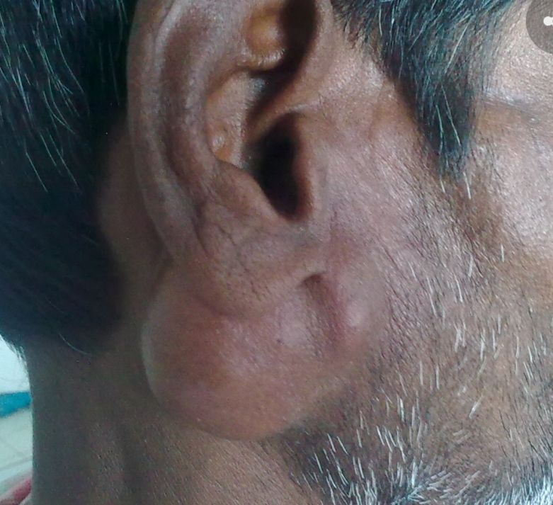 Λεμφαδενικός Χειρουργικός Καθαρισμός Τραχήλου