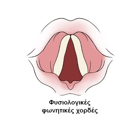 Βράγχος Φωνής - Βραχνάδα