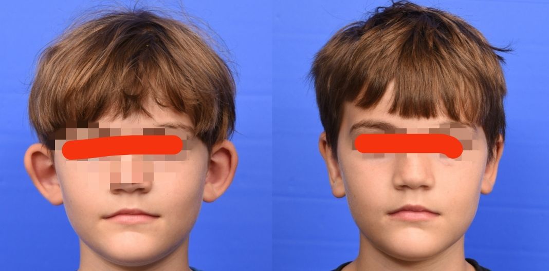 Ωτοπλαστική