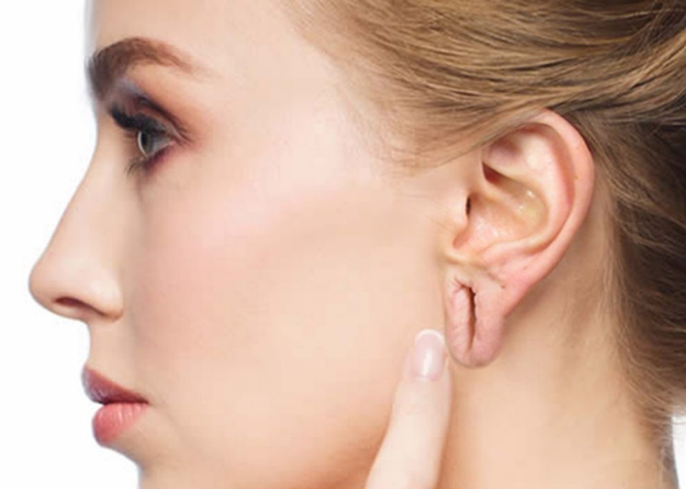 Ωτοπλαστική